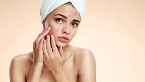 أهم 6 طرق للتخلص من حب الشباب.. الأعراض وعلاجه 