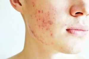 أهم 6 طرق للتخلص من حب الشباب.. الأعراض وعلاجه 
