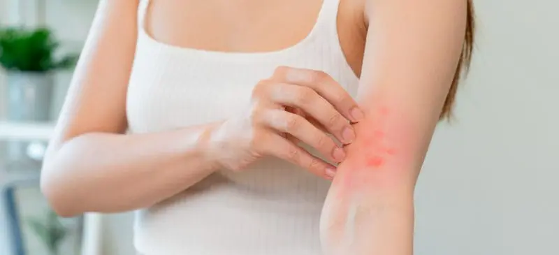 علاج الأكزيما بطرق مجربة و مفيدة.. إليكم اهم 9 طرق طبية