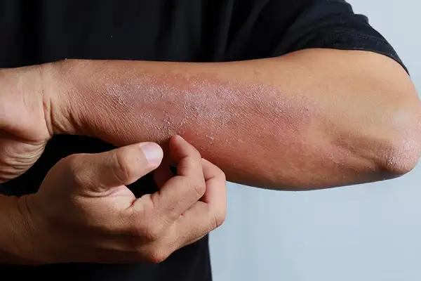 علاج الأكزيما بطرق مجربة و مفيدة.. إليكم اهم 9 طرق طبية