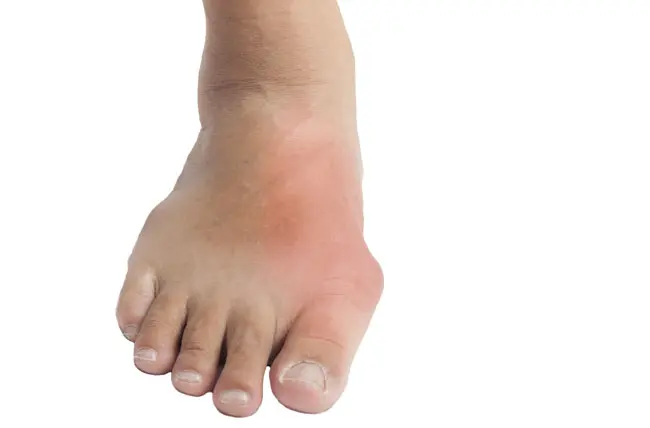 علاج النقرس وأعراضه وأسباب حدوثه .. 7 طرق علاجيه من المنزل
