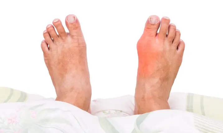 علاج النقرس وأعراضه وأسباب حدوثه .. 7 طرق علاجيه من المنزل