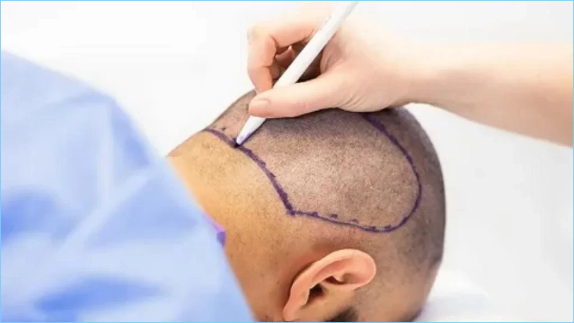 زراعة الشعر في الرياض