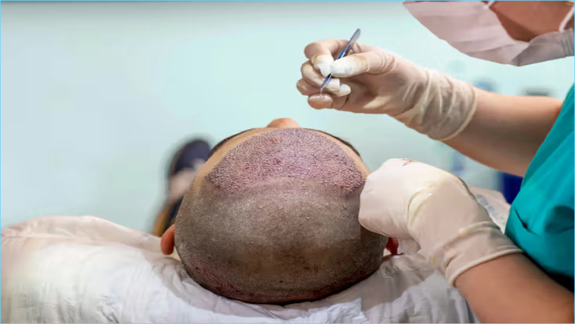 زراعة الشعر في الرياض