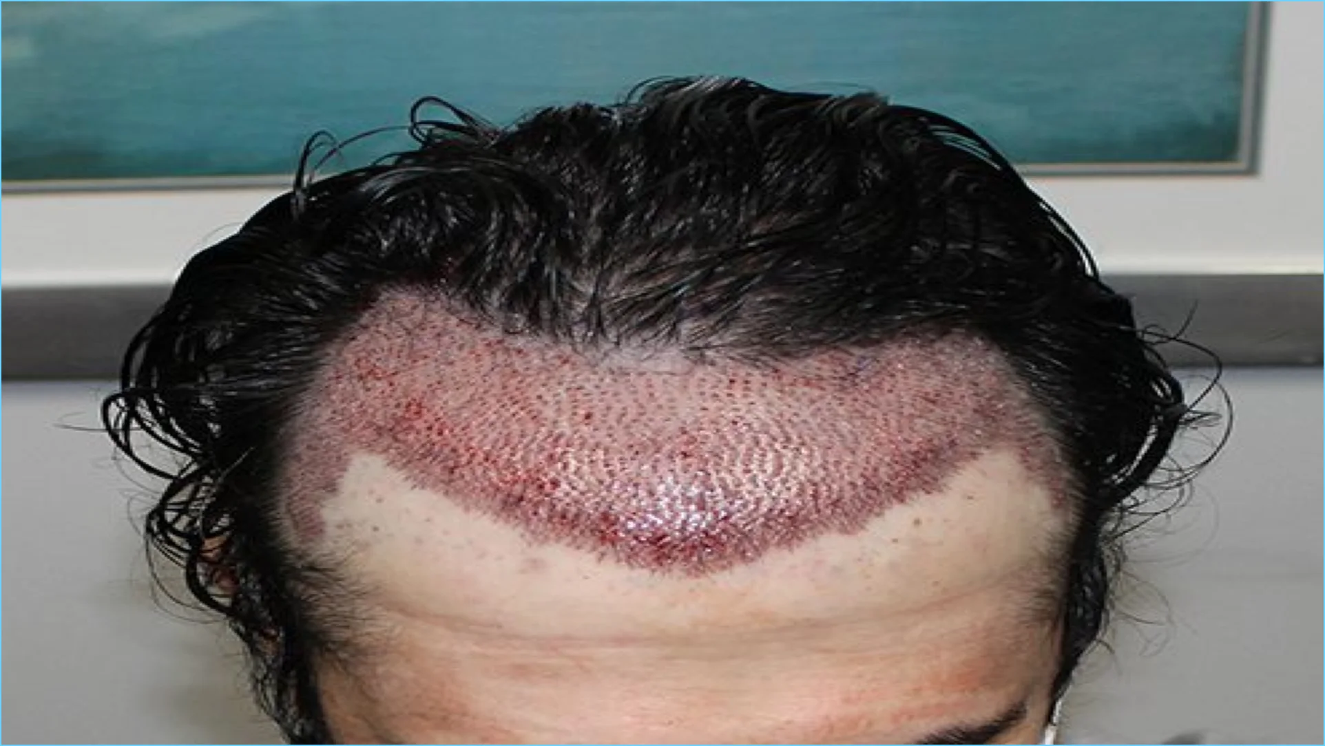 زراعة الشعر في الرياض