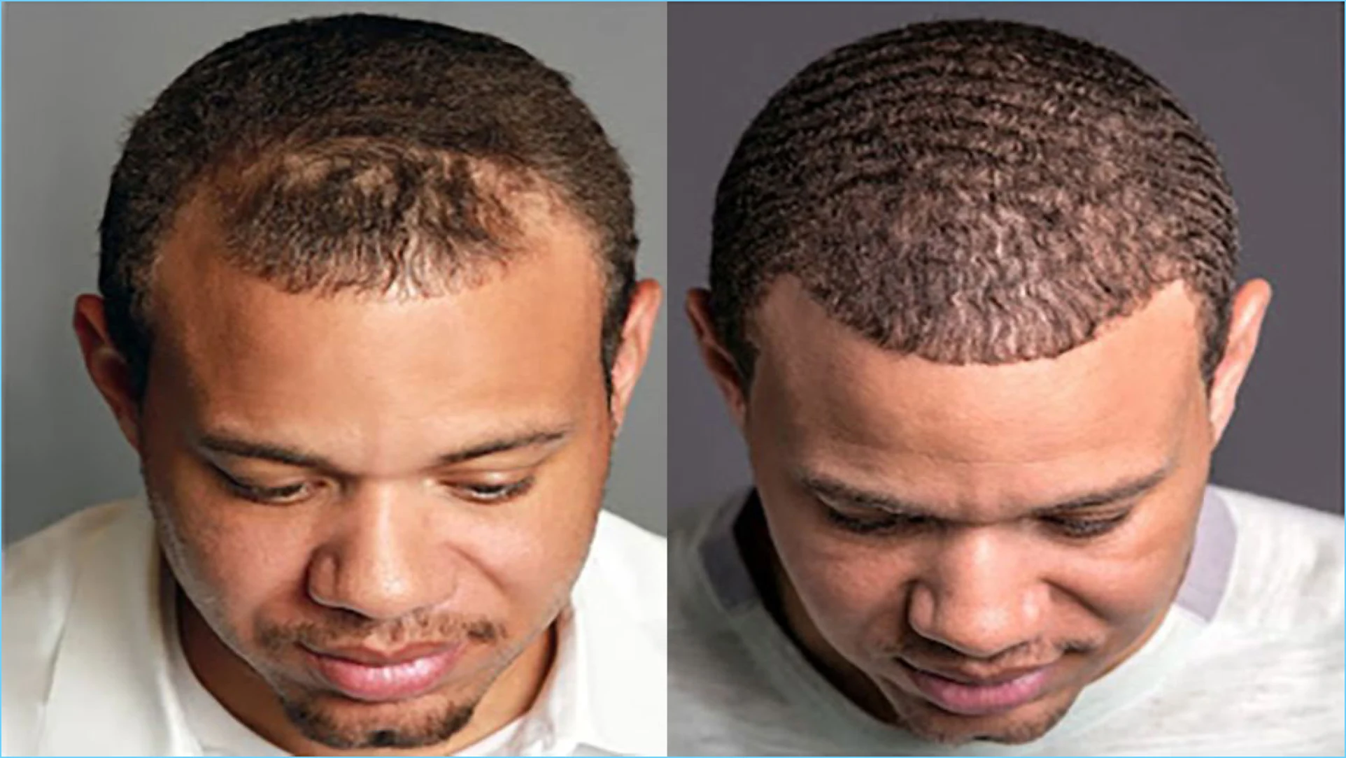 زراعة الشعر في الرياض